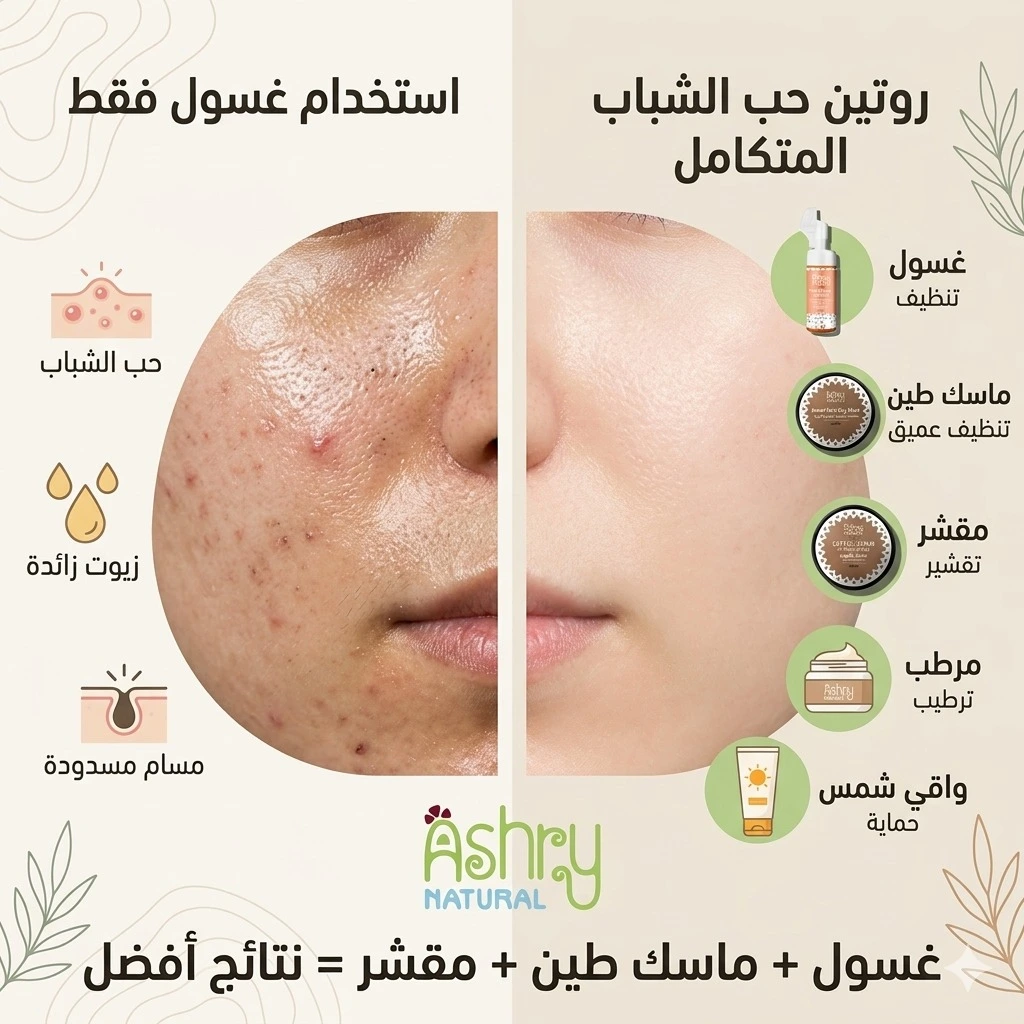الفرق بين استخدام غسول فقط وروتين حب الشباب المتكامل الذي يشمل غسول وماسك طين ومقشر
