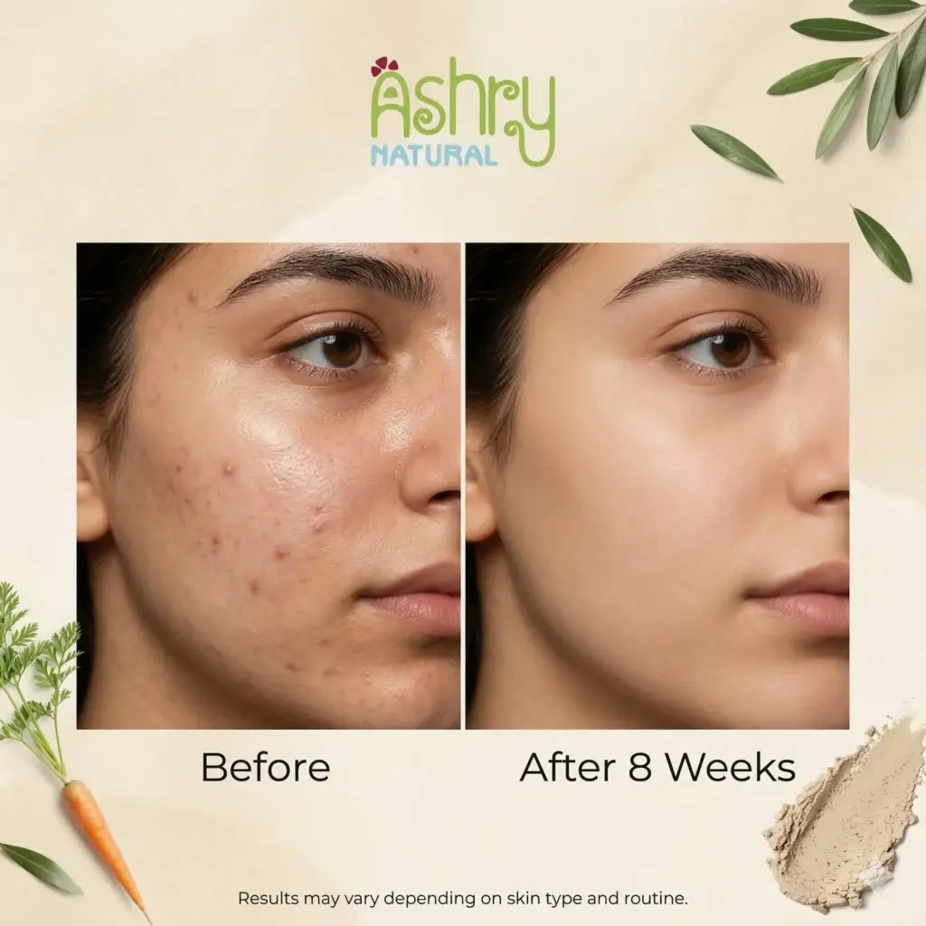تحسن حب الشباب قبل وبعد 8 أسابيع من الالتزام بروتين العناية بالبشرة الطبيعية