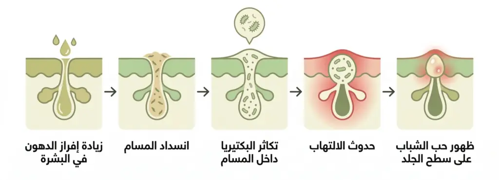 رسم توضيحي يشرح مراحل تكوّن حب الشباب: زيادة إفراز الدهون في البشرة ثم انسداد المسام وتكاثر البكتيريا وحدوث الالتهاب وصولًا إلى ظهور الحبوب على سطح الجلد